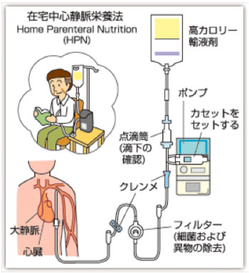 在宅中心静脈栄養法